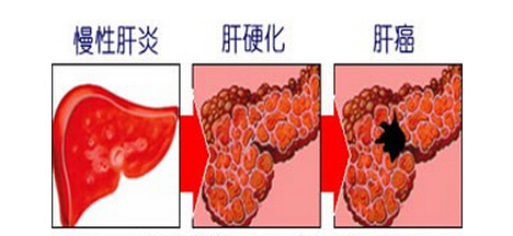 【病因】肝硬化形成的原因有哪些